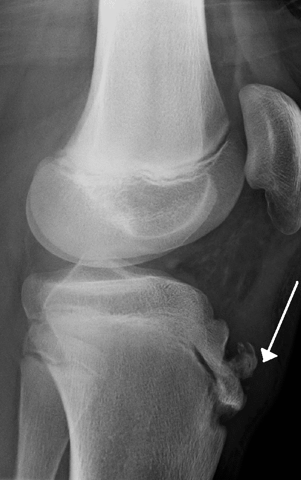 Chụp X-Quang chẩn đoán bệnh Osgood-Schlatter