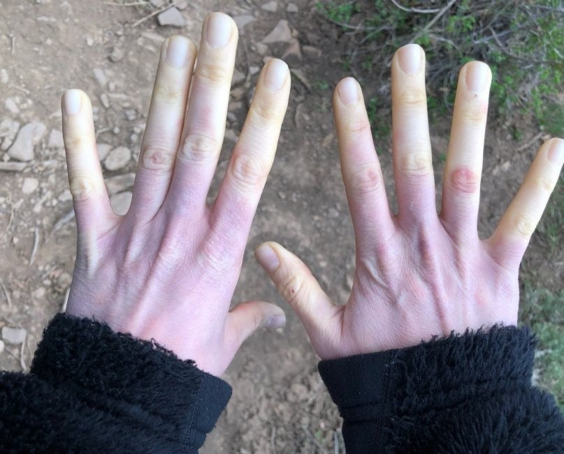 Hội chứng Raynaud ở bàn tay