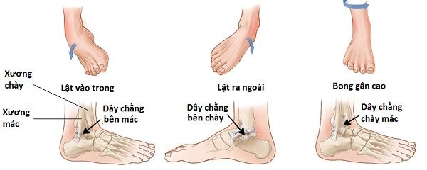 Các loại tổn thương dây chằng vùng cổ chân