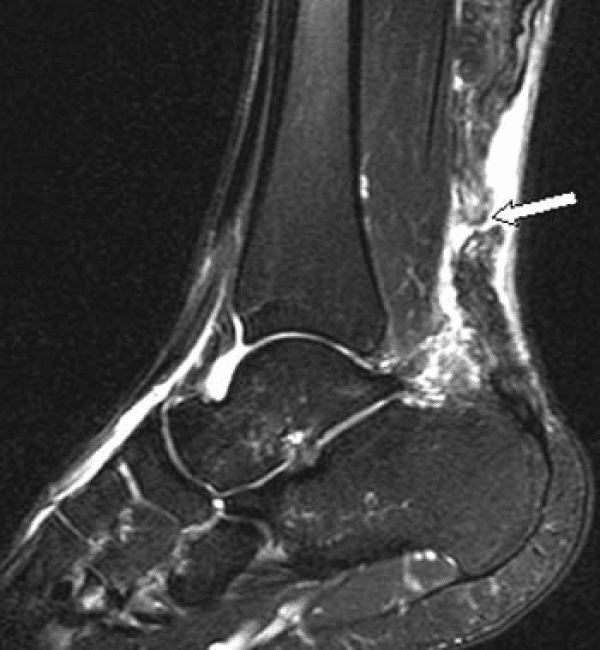 Hình ảnh MRI đứt gân gót