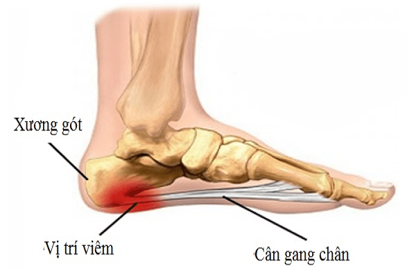 Viêm cân gan chân là nguyên nhân thường gặp nhất của đau gót chân