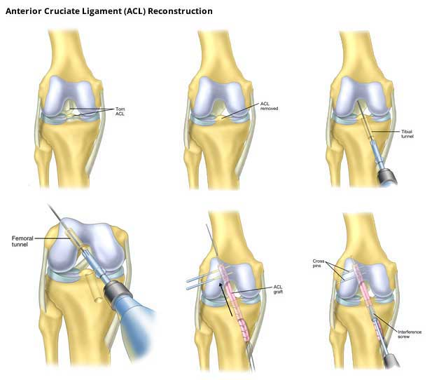 Phẫu thuật tái tạo dây chằng chéo trước