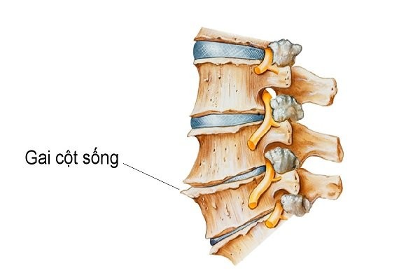 Gai cột sống