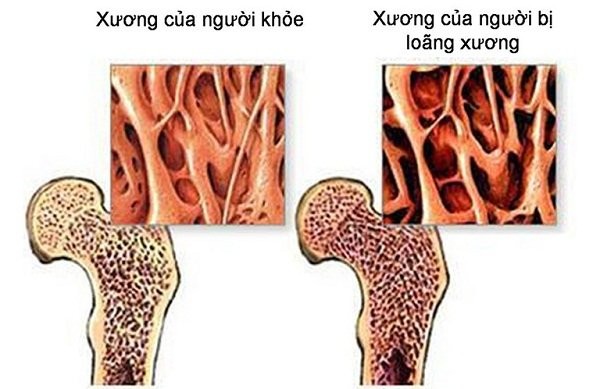 Gãy cổ xương đùi và những điều bạn cần biết về bệnh 