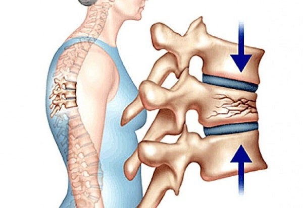 Gãy lún đốt sống có thể gây gù cột sống.