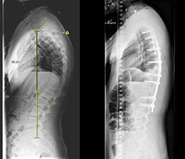 trước và sau phẫu thuật chỉnh gù