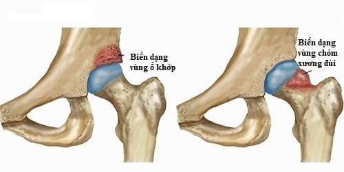 Các tổn thương dẫn đến hẹp khớp háng