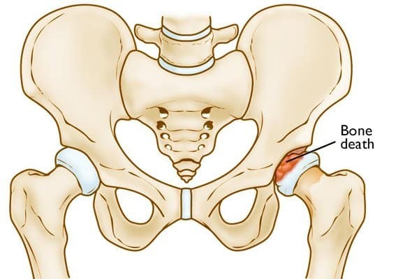 Bệnh Legg-Calve-Perthes cũng có thể khiến bạn bị hẹp khớp háng