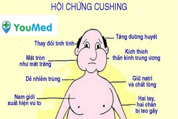 Hội chứng Cushing