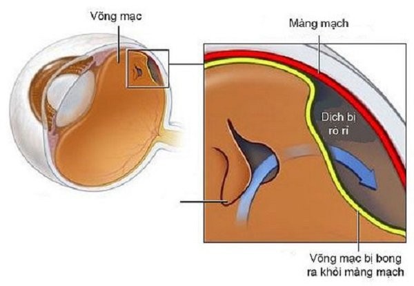 Hiện tượng bong võng mạc