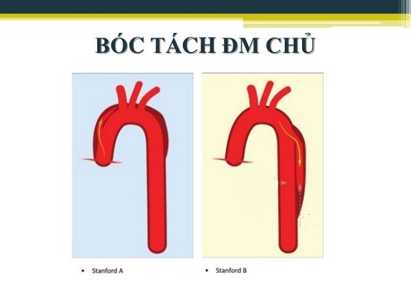 Hội chứng Marfan: bất thường di truyền hiếm gặp và những điều cần biết