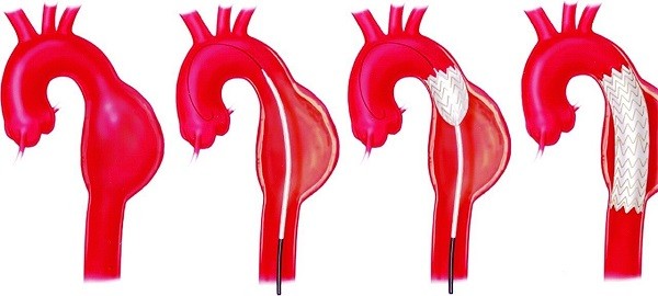 Hội chứng Marfan: bất thường di truyền hiếm gặp và những điều cần biết