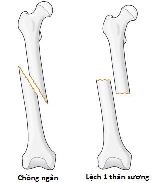 Gập góc giữa 2 đoạn gãy xương chân