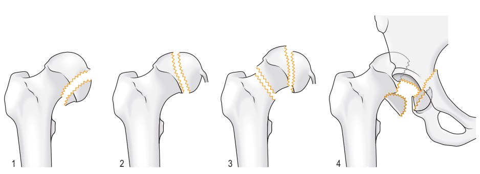 Các phân độ của gãy chỏm xương đùi