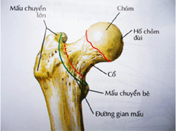 Gãy mấu chuyển bé đơn độc