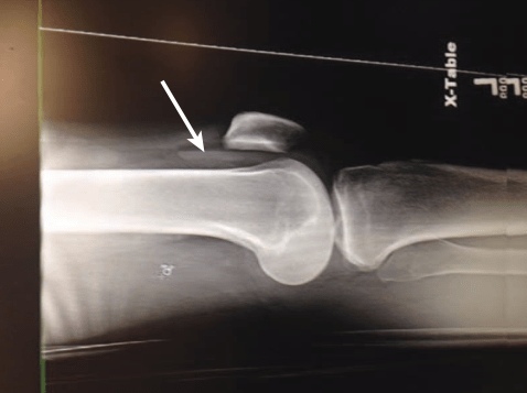 mức dịch mỡ (Fat-fluid level)