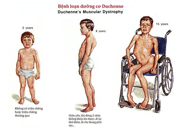 Triệu chứng và dấu hiệu bệnh loạn dưỡng cơ Duchenne