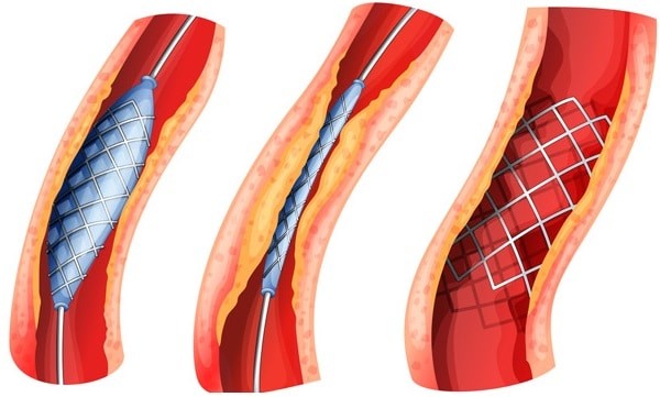 Phẫu thuật tái thông mạch máu