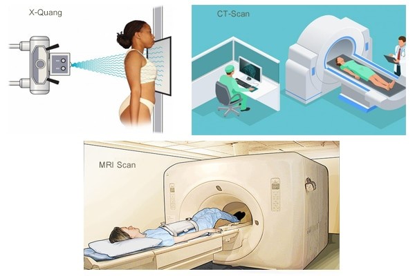 Một số phương pháp giúp chẩn đoán mỏm gai xương bả vai