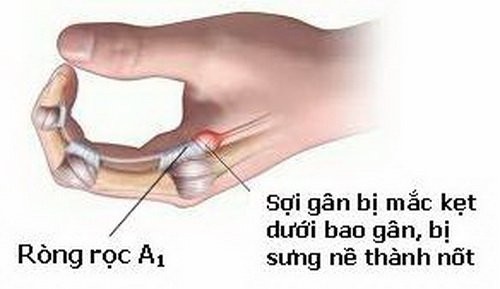 Sợi gân bị viêm, mắc kẹt tại vị trí ròng rọc, sưng nề, làm ngón tay khó cử động