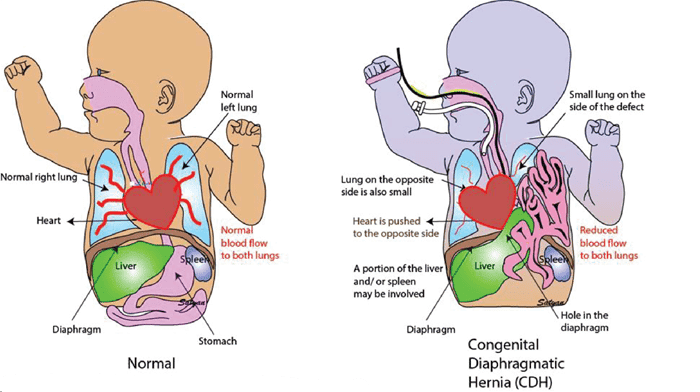 Thoái vị hoành bẩm sinh ở trẻ em