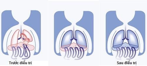 phẫu thuật thoát vị cơ hoành