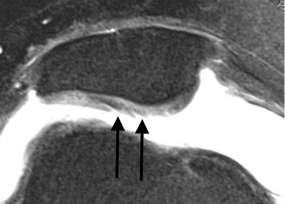 Hình ảnh rách sụn chêm qua MRI