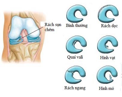 Các dạng thương tổn của sụn chêm