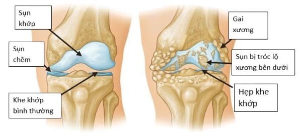 Hình minh hoạ khớp gối bình thường. Khớp gối khoẻ mạnh khi các thành phần tạo nên nó có cấu trúc bình thường và hoạt động trơn tru