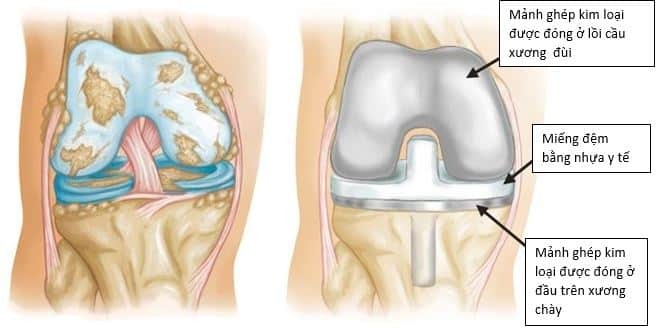 Minh họa về thoái hóa khớp nặng và thay khớp gối toàn phần. (Trái) Thoái hoá khớp nặng. (Phải) Sụn khớp và xương bên dưới đã được loại bỏ và tái tạo bề mặt bằng các mảnh ghép kim loại vào xương đùi và xương chày. Một miếng đệm bằng nhựa được đặt ở giữa giúp bệnh nhân đi đứng trên “miếng nhựa”
