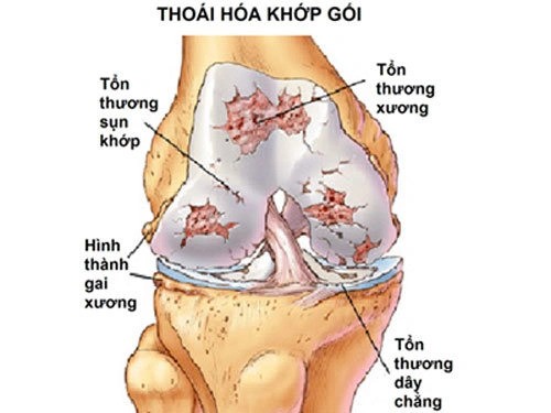 Các tổn thương trong thoái hóa khớp gối