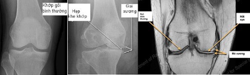 Hình trái: khớp gối bình thường. Hình giữa: Khớp gối thoái hóa. Hình phải: phim chụp MRI cùng khớp hình giữa.