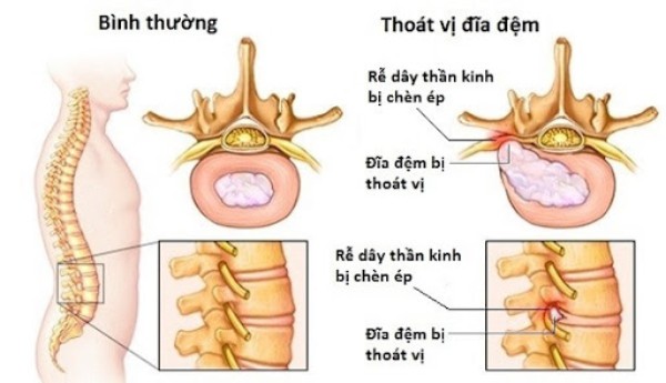 Hình ảnh thoát vị đĩa đệm thắt lưng 