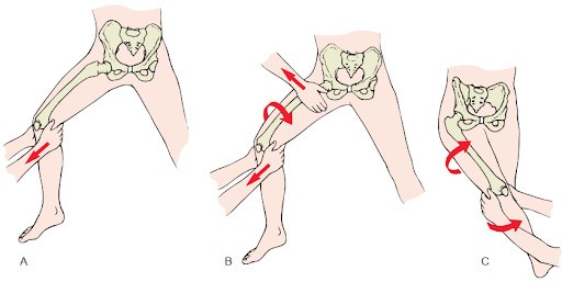 Nắn trật khớp háng với phương pháp Allis