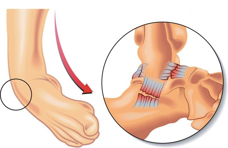 Nguy cơ bị trật mắt cá chân lớn nhất trong các hoạt động liên quan đến chuyển động sang bên.