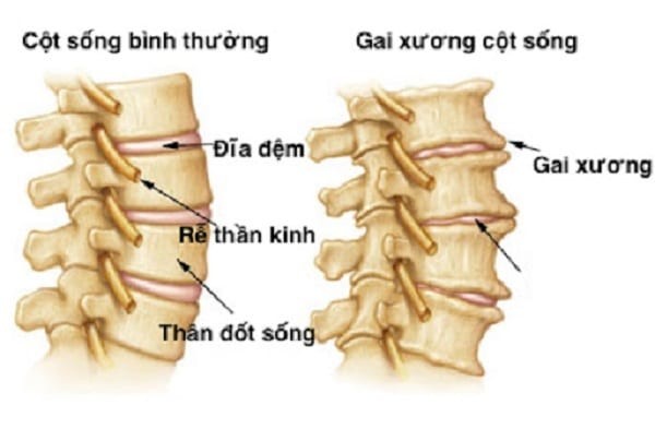 Hình thành gai cột sống.